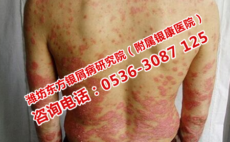 如何治疗银屑病恢复
