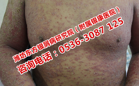 阴冷冬季如何护理银屑病