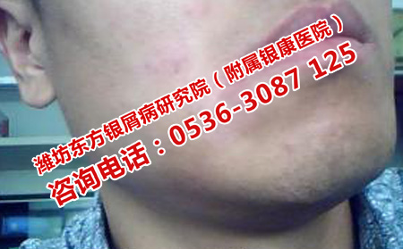 治疗男性银屑病的细节