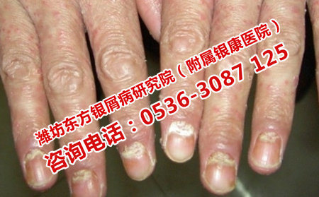 银屑病恢复需要健康的心理