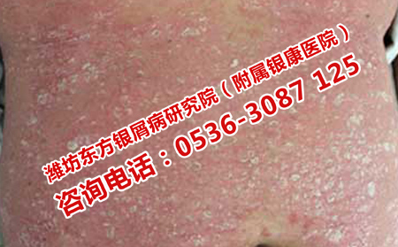 济南专门治银屑病的单位