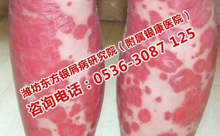 安丘治疗红皮型银屑病