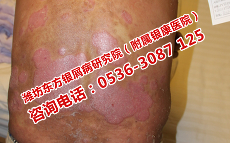 奎文区有专门的银屑病医院吗