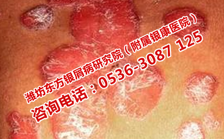 银屑病反复出现的原因