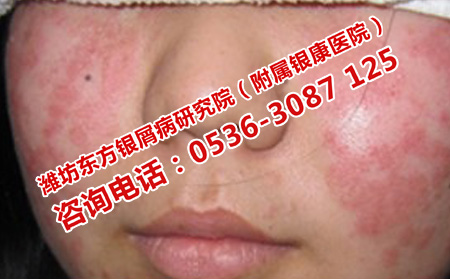 孩子的牛皮癣危害如何降低
