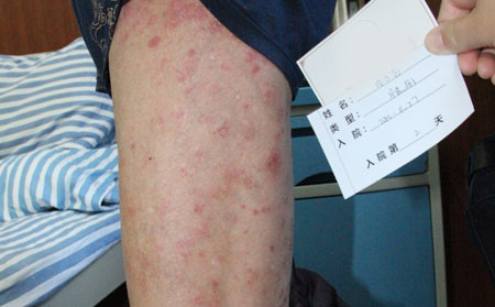 济南可以的银屑病医院该怎么去