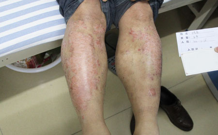 济南治疗银屑病的医院