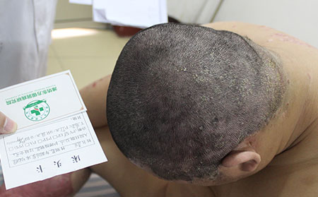 头部银屑病的日常护理
