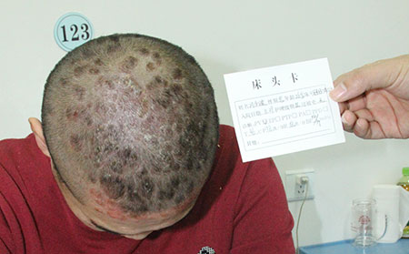 感冒对牛皮癣的不利影响
