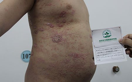 牛皮癣的真正病因是什么