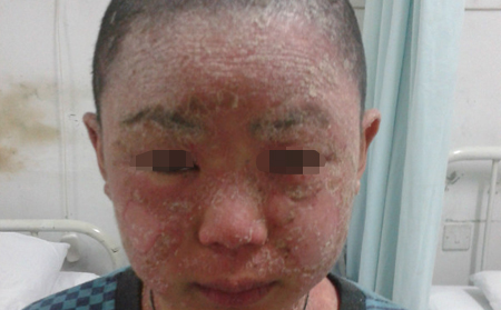 治疗银屑病用药须知
