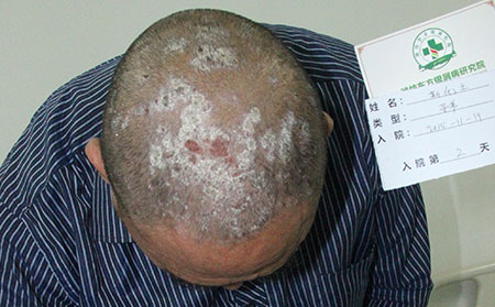 预防老人银屑病久治不愈
