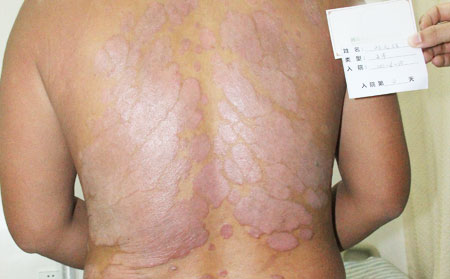治银屑病注意什么
