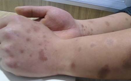牛皮癣究竟是如何引起的呢