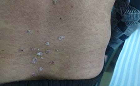 怎么去降低牛皮癣的发病率