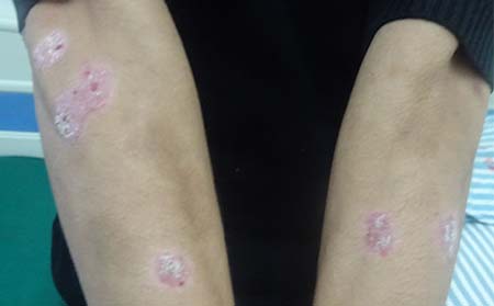 牛皮癣患者不要做的几件事