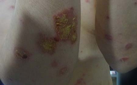 牛皮癣会不会被治可以呢