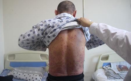 针对顽固性牛皮癣有没有可以的药物可以使用