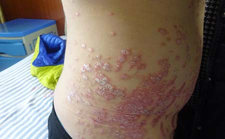 牛皮癣的严重皮损如何消除