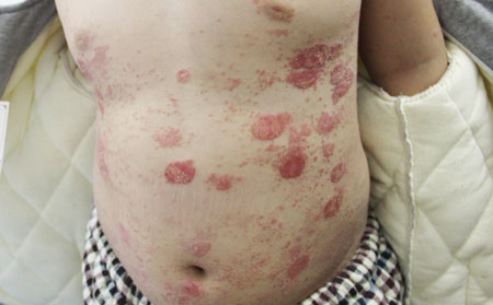 牛皮癣有多少危害