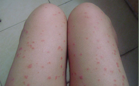 银屑病症状