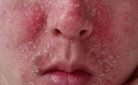 牛皮癣症状