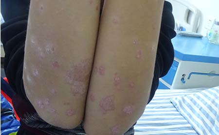 银屑病为何很快反复