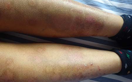 银屑病前期什么症状