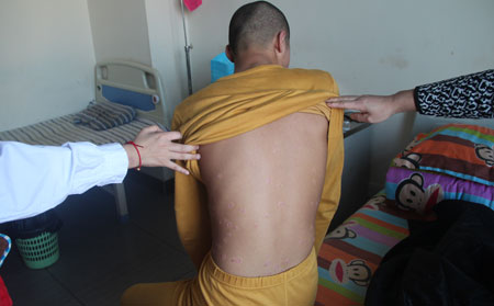 银屑病轮换治疗的介绍