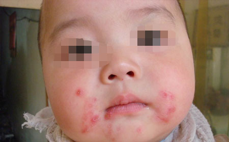 银屑病有什么表现