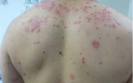 如何预防银屑病扩散
