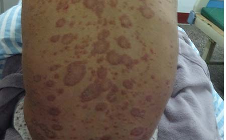 银屑病患者如何缓解心理压力