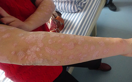 关节型银屑病的危害